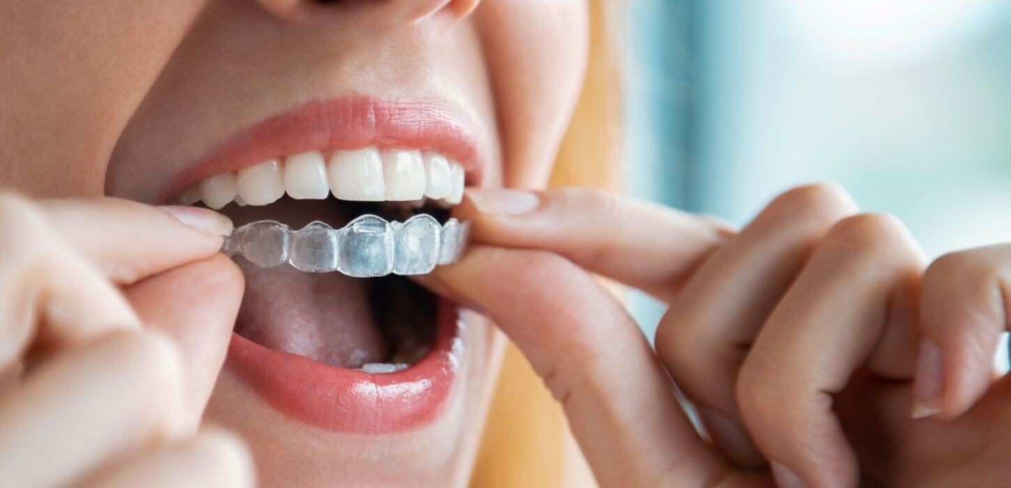 التعويضات السنية 